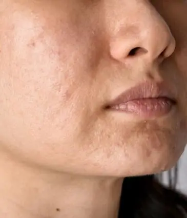 MAESKN Aesthetics - Acne Scarring