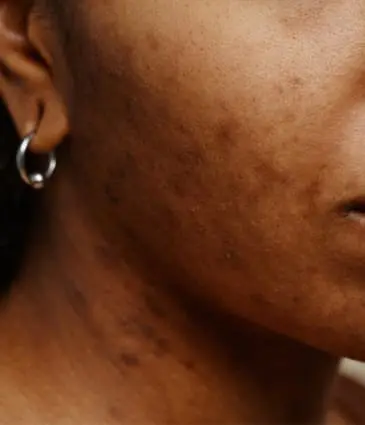 MAESKN Aesthetics - Acne Scarring