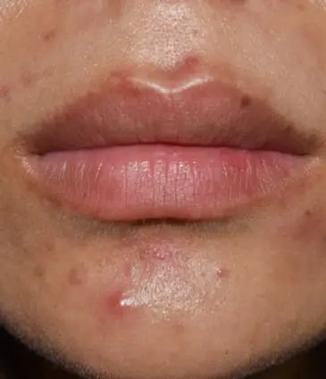 MAESKN Aesthetics - Active Acne