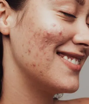 MAESKN Aesthetics - Active Acne