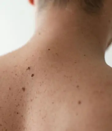 MAESKN Aesthetics - Benign Skin Lesions