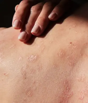 MAESKN Aesthetics - Eczema