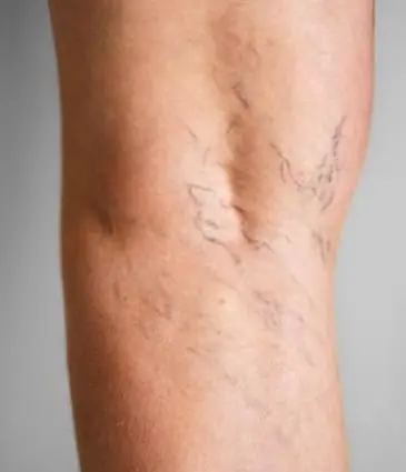 MAESKN Aesthetics - Leg Veins - Spider & Reticular