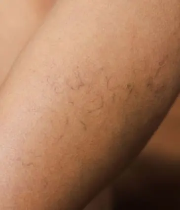 MAESKN Aesthetics - Leg Veins - Spider & Reticular