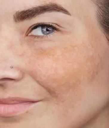 MAESKN Aesthetics - Melasma