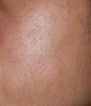 MAESKN Aesthetics - Open & Enlarge Pores