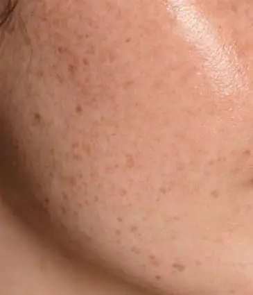 MAESKN Aesthetics - Pigmentation & Sun Damage