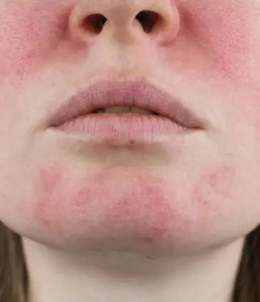 MAESKN Aesthetics - Rosacea