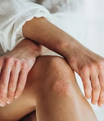 MAESKN Aesthetics - psoriasis