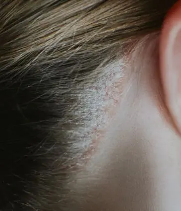 MAESKN Aesthetics - psoriasis