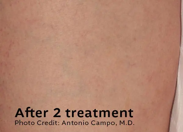 Leg Veins After Treatment