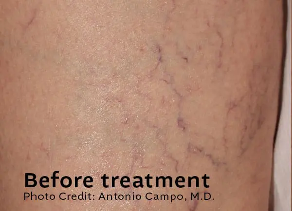 Leg Veins Before Treatment