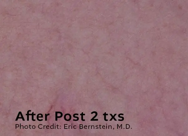 Leg Veins After Treatment