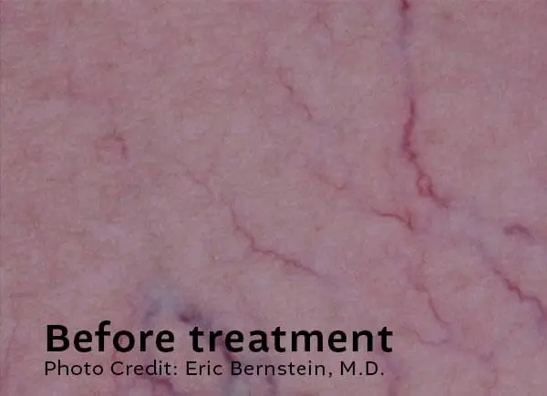 Leg Veins Before Treatment