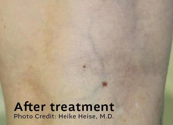 Leg Veins After Treatment
