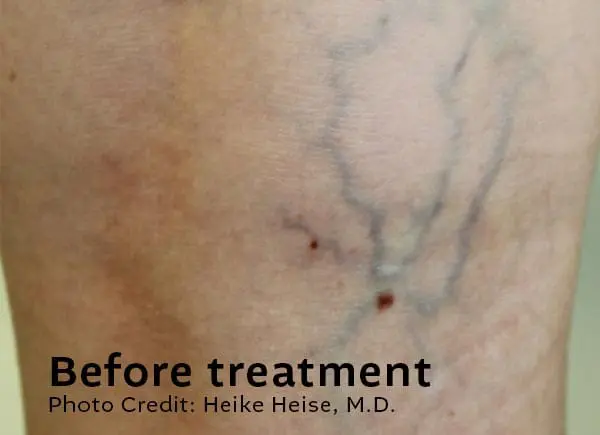 Leg Veins Before Treatment