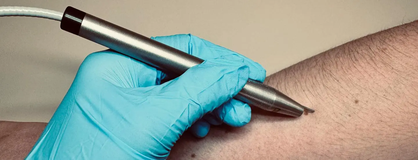 MAESKN Aesthetics - Benign Skin Leisons