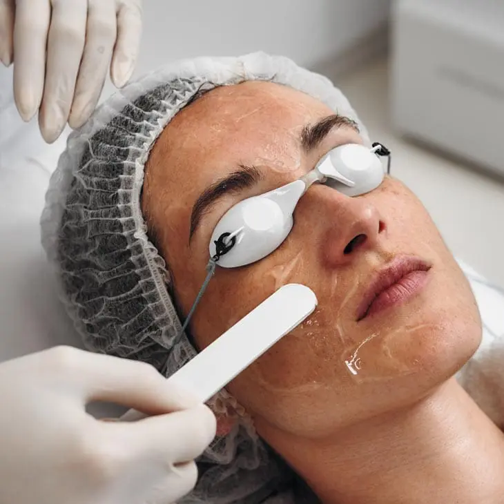 MAESKN Aesthetics - Facial Thread Veins 1