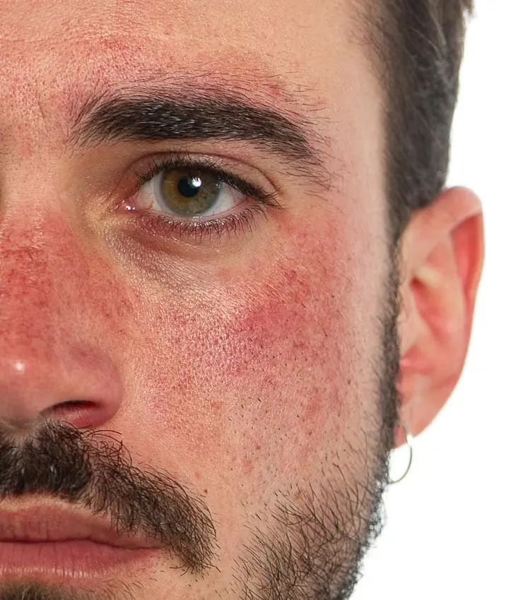 MAESKN Aesthetics - Facial Thread Veins 2