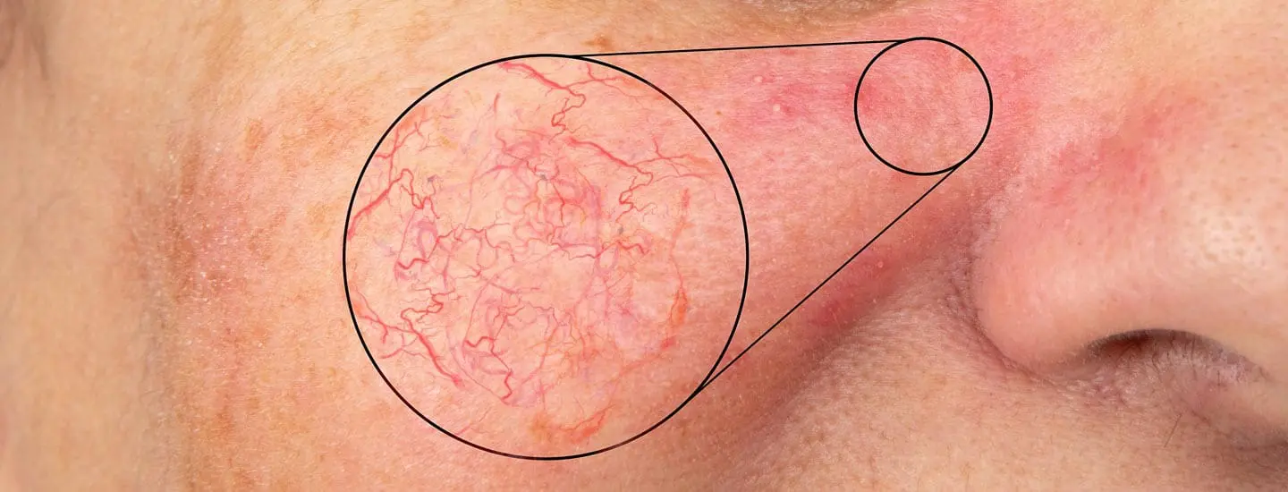 MAESKN Aesthetics - Facial Thread Veins