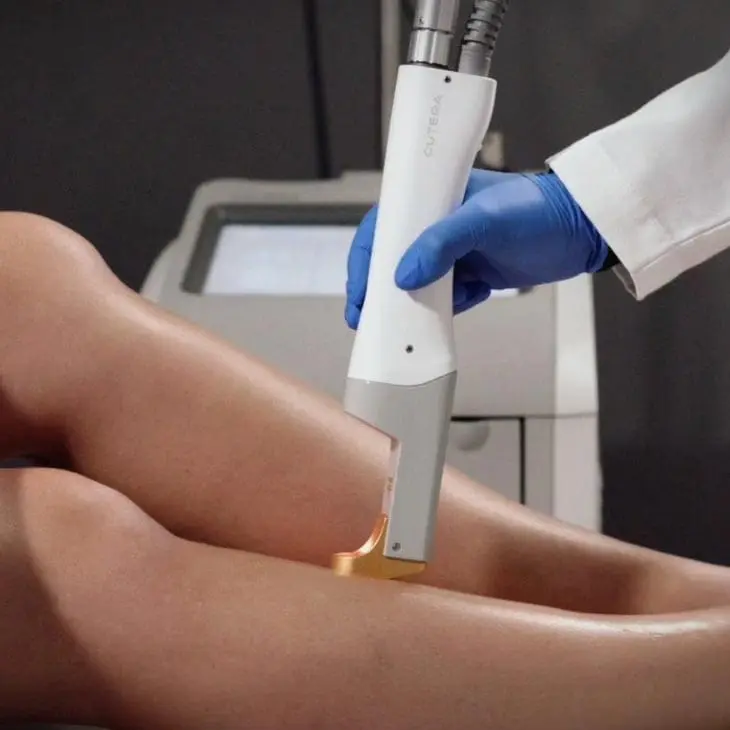 MAESKN Aesthetics - Leg Veins 2