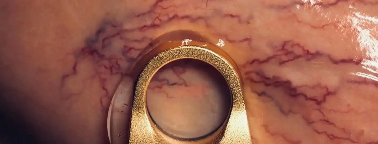 MAESKN Aesthetics - Leg Veins