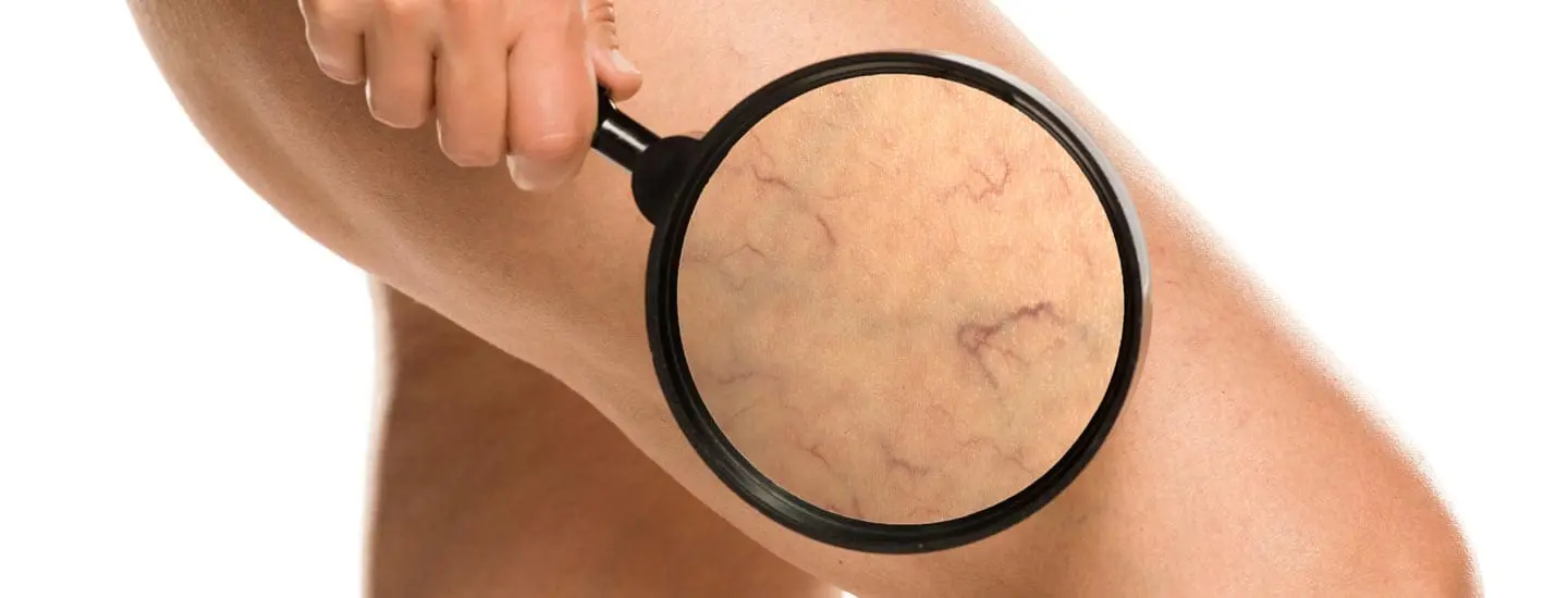 MAESKN Aesthetics - Leg vein consultation