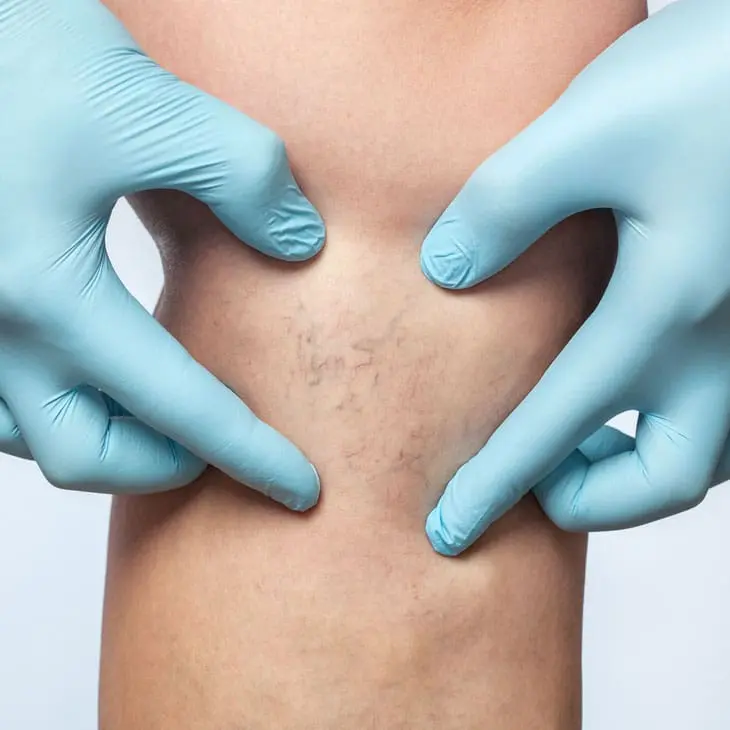 MAESKN Aesthetics - Leg vein consultation 2