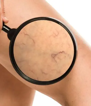 MAESKN Aesthetics - Leg vein consultation