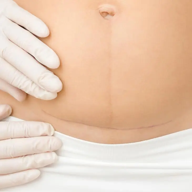 MAESKN Aesthetics - Post Surgical Scarring 1