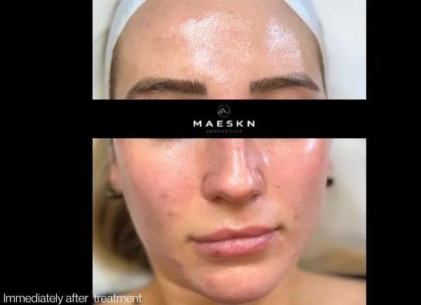after picture of hydro platinum facial