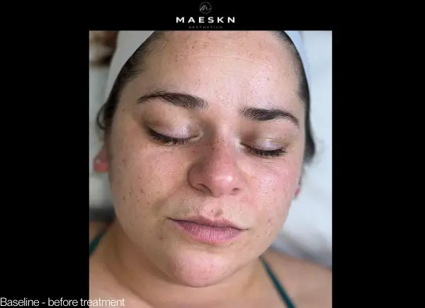 before hydrofacial treatment