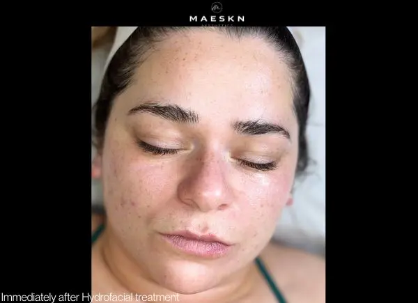 immediately after hydrofacial treatment