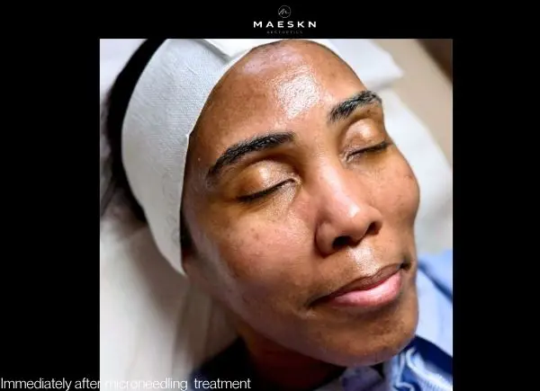 after microneedling treatment