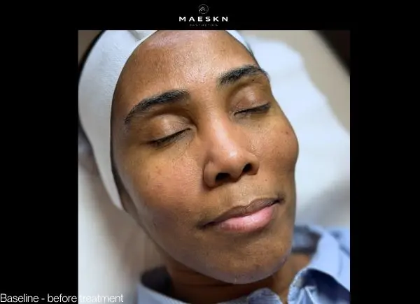 before microneedling treatment