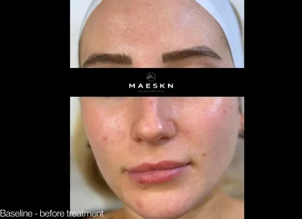 before hydrofacial platinum treatment
