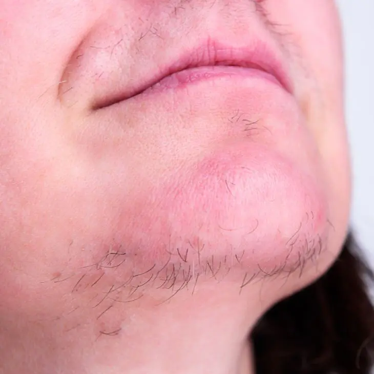 facial hair growth - laser hair removal content image 1