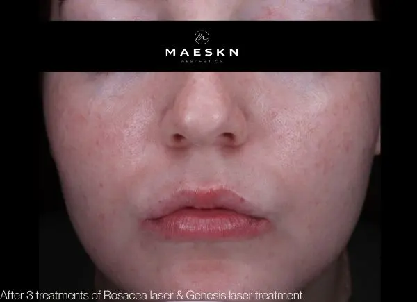after picture for rosacea laser treatment