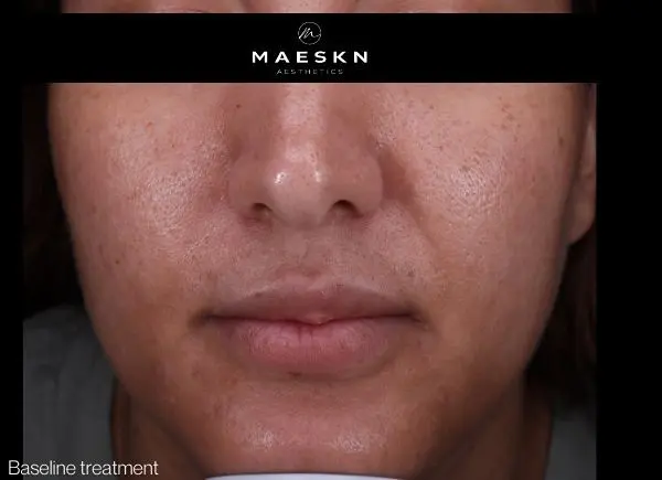 before peel and microneedling treatment