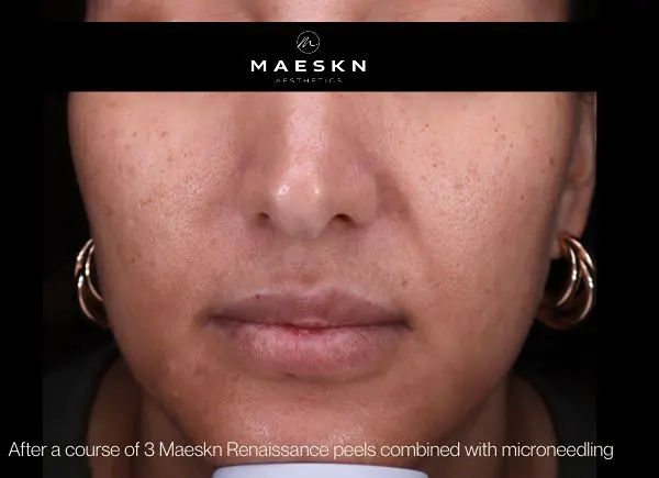 after peel and microneedling treatment