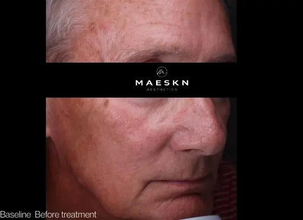 before laser pigmentation picture