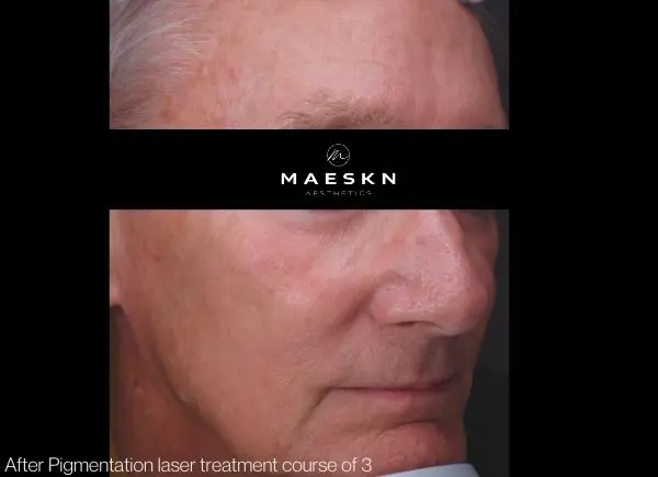 after pigmentation laser treatment