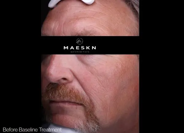 pigmentation laser treatment before picture 2