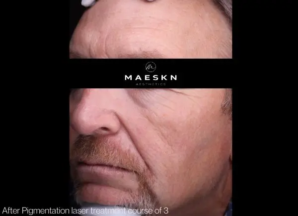 pigmentation laser treatment after picture