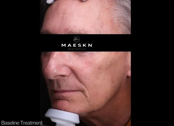 after pigmentation laser treatment picture