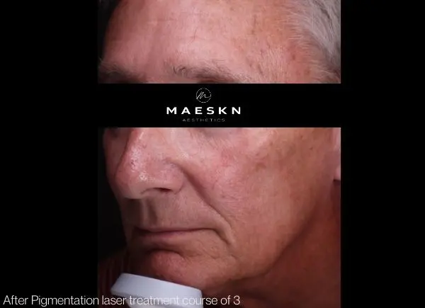 Before pigmentation laser treatment picture
