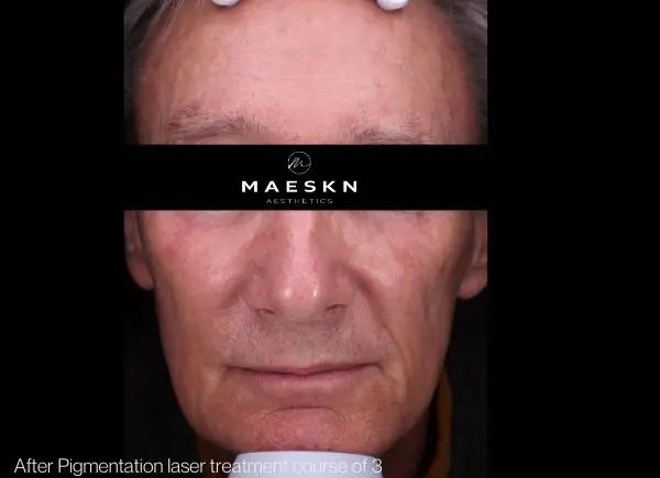 after pigmentation laser treatment picture
