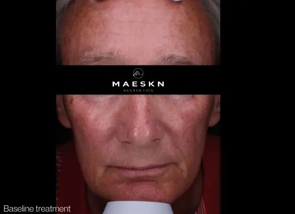 before pigmentation laser treatment 1