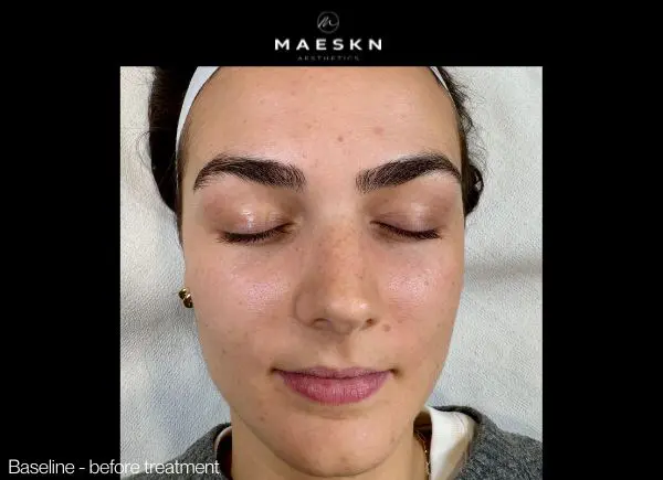 before no down time laser facial and microneedling