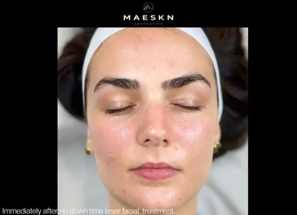 immediately after no down time laser facial